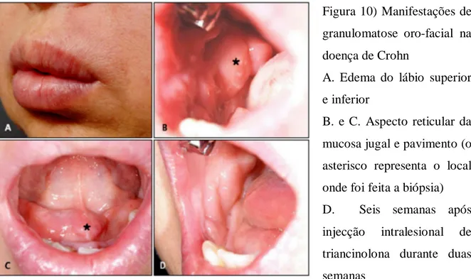 Figura 11) Lesões de  granulomatose oro-facial na  doença de Crohn 