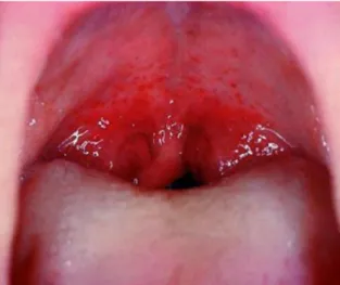 Figura  2)  Eritema  do  palato  mole  e  úvula  num  paciente  com  doença  do  refluxo  gastroesofágico  (Fede  O,  Di  Liberto  C,Occhipinti  G,  Vigneri  S,  Russo  L,  Fedele  S,  et  al