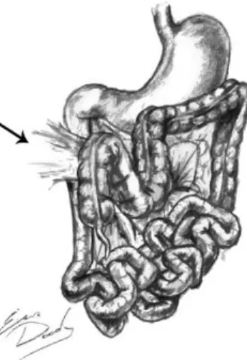 Figura 1 - Má Rotação Intestinal. Duodeno e junção duodenojejunal no lado direito da cavidade abdominal