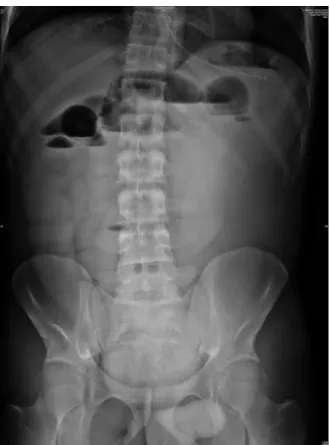 Figura 5 - Radiografia do abdómen em pé realizada na Urgência (9-4-2016) 