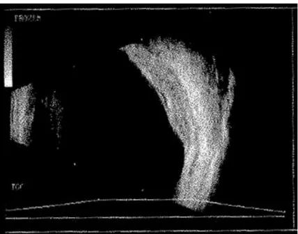 Figura 1- Ultrassonografia OD de Outubro de 2015- Lesão lobulada de grandes dimensões, no quadrante temporal- temporal-superior, com maior espessura entre os 3-4mm, associado a um descolamento da retina exsudativo