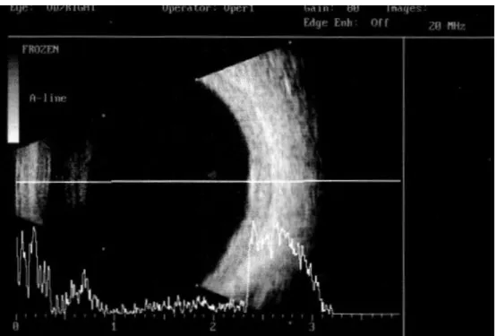Figura 4-  Tomografia de coerência óptica (OCT) OD de Janeiro de 2016. Alterações da anatomia normal da neuro- neuro-retina e do epitélio pigmentado secundários à lesão tumoral primária