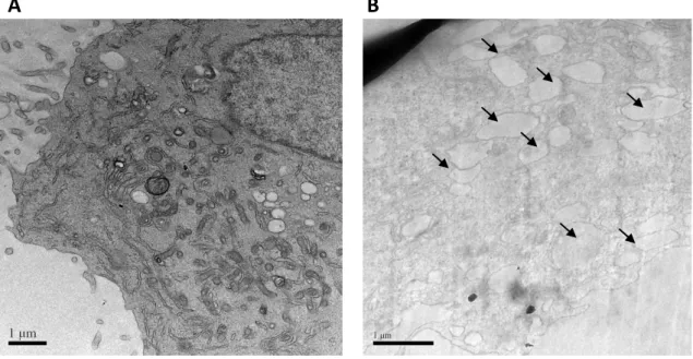 Figura  5  -  Aspecto  de  células  da  linhagem  PC3  (adenocarcinoma  de  próstata  humano  resistente a androgênios) à microscopia eletrônica de transmissão antes (A) e após 6 horas de  tratamento com extrato hexânico da folha da Allamanda blanchetii (B