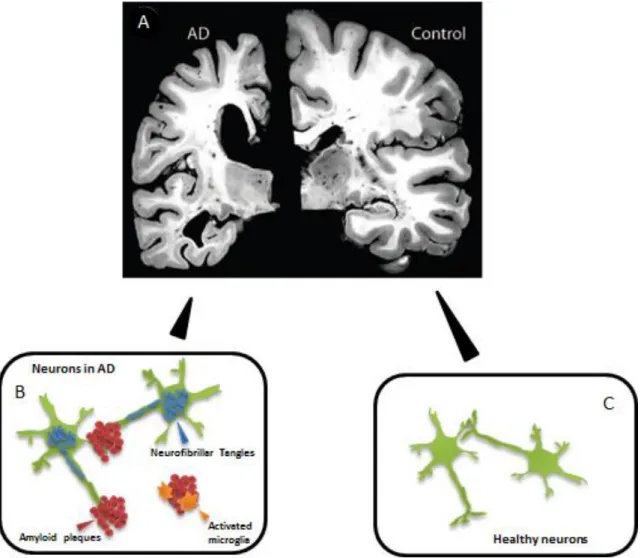 Fig. I.1: Neuropathology of Alzheimer’s Disease.  (A) Extensive atrophy is observed in later stages of  Alzheimer’s  Disease  (AD),  which  is  accompanied  by  enlarged  ventricles,  narrowed  cortical  gyri  and  widened  sulci