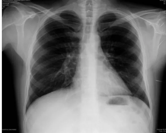 Fig. 1 – Normal chest x-ray performed  before anti-TNF therapy. 