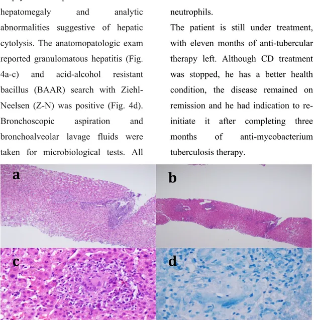 Fig.  4  –  a:  Photomicrograph  showing  tuberculous  granuloma  with  Langhan  giant  multinucleated cell and lymphocytes palisade (H&amp;E stain, x40); b: Photomicrograph  showing  portal  space  with  lymphocytic  infiltrate  (H&amp;E  stain,  x10);  c