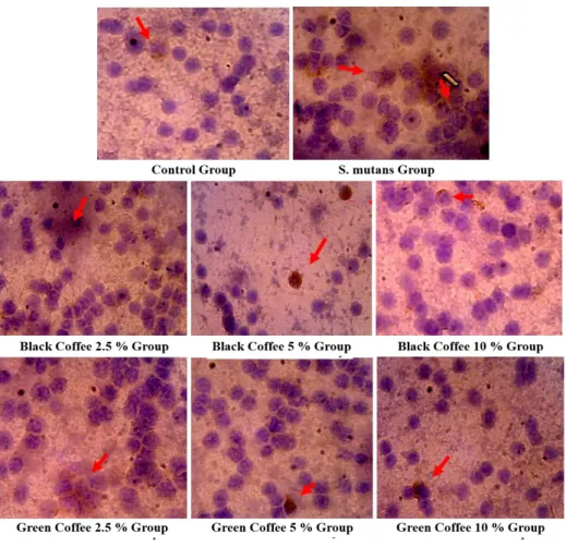 FIGURE 3  -  Monocytes  that  express  IL–1β  are  brown  (black  arrow). Analyzed  with  light  microscope  with  magnification 1 000 x
