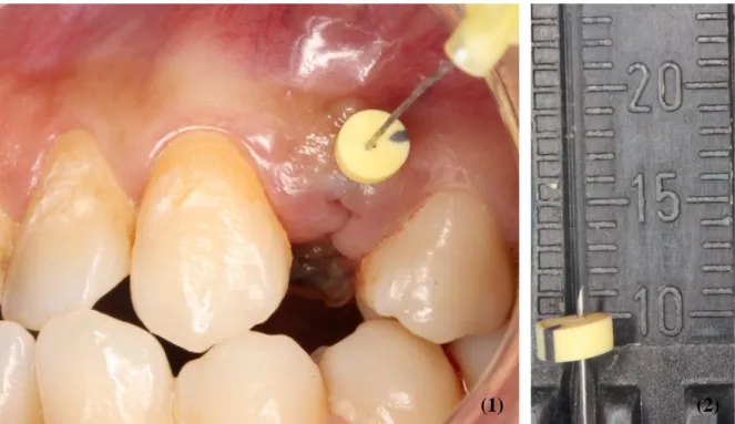 Figura 3- Medição da espessura da gengiva em vestibular do dente a extrair (1) e  confirmação do valor (2) 
