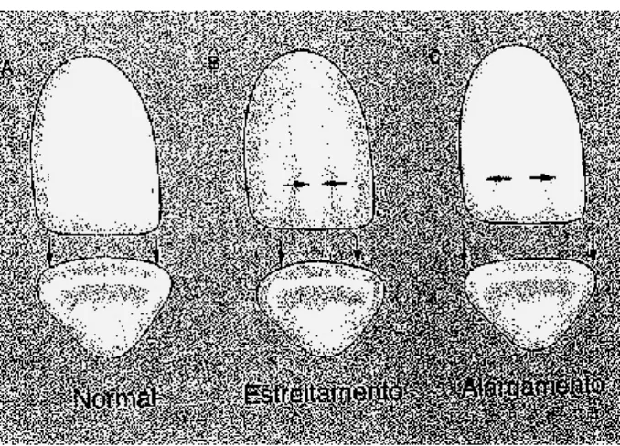Figura 7 - Como criar ilusões de largura. A - dente de largura normal; B - aparenta ser mais estreito  devido às linhas dos ângulos mesial e distal estarem mais próximas, e pela aproximação dos sulcos de 