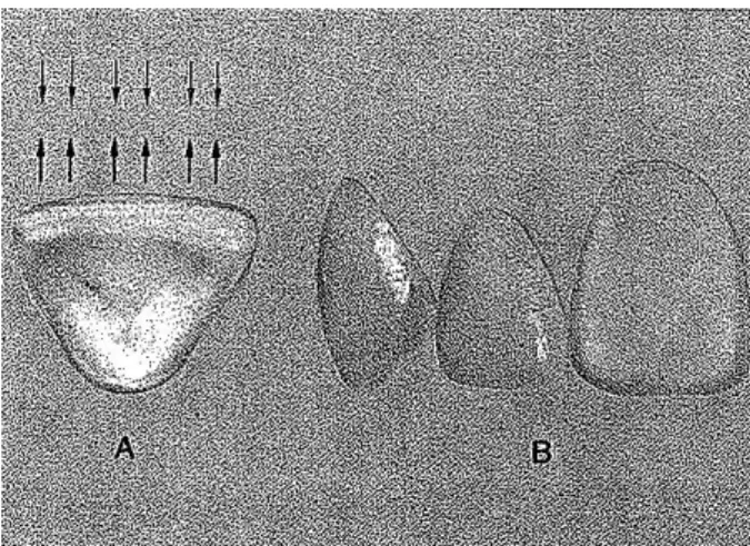Figura 13 - Ilusão de estreitamento dentário. (imagem gentilmente cedida por Mondelli J