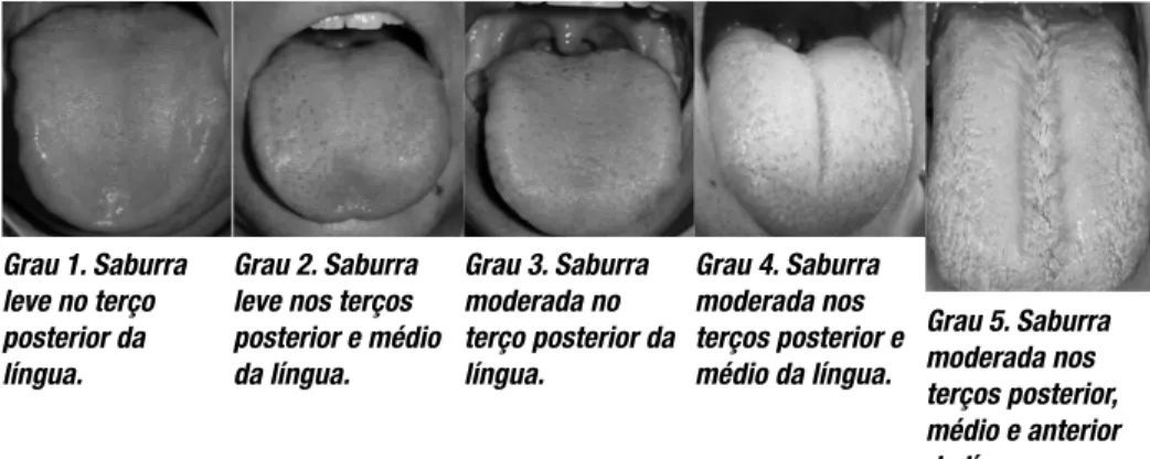 Figura 4. Graus de formação da saburra lingual: (30)