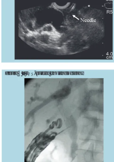 Figure 1 – EUS linear image demonstrating CDB dilatation