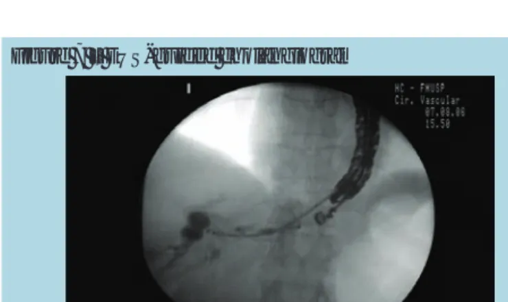 Figure 6 – A: EUS image demonstrating dilated left biliary  branch/B: EUS image demonstrating puncture of a left biliary  branch (intrahepatic approach)