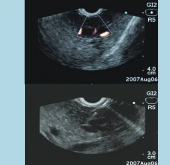 Figure 7 – EUS-guided cholangiogram