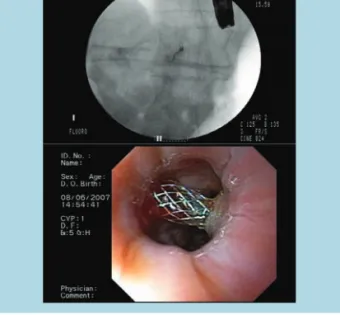 Figure 8 – A: radiologic image of the PC-SEMS/