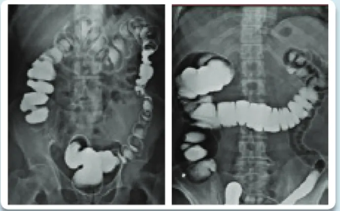 Figura 1. Enemas opacos evidenciando Grau 0 da ptose do  colo transverso.   