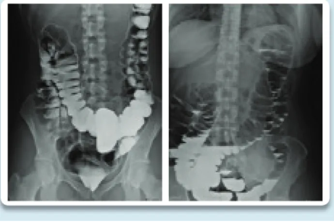 Figura 3. Enemas opacos evidenciando Grau 2 da ptose do  colo transverso. 