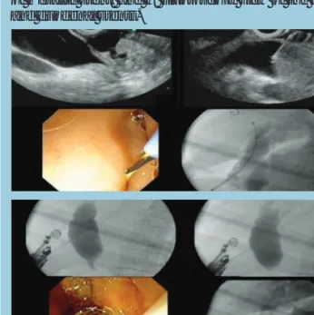 Figure 2: Image sequence of a EUS-guided 