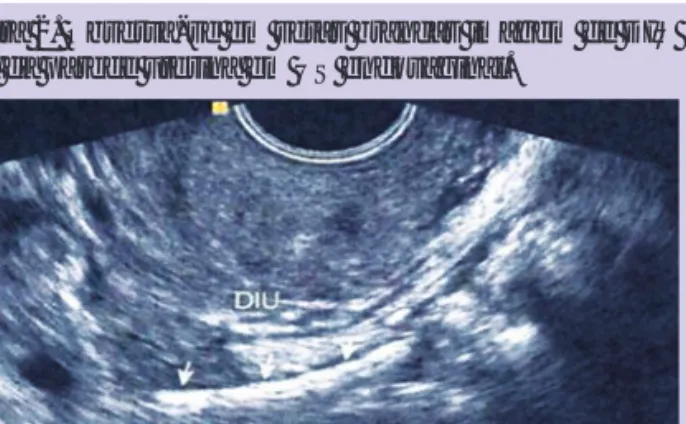 Figura 2. Observa-se em setas brancas imagem de DIU  fora da parede uterina em US endovaginal.