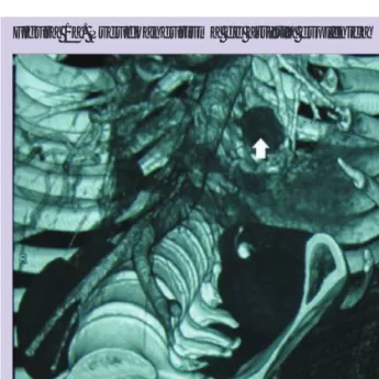 Figura 1a. Pseudoaneurisma de artéria esplênica