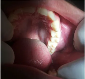 FIGURA 2: foto intraoral mostrando tumefação nodular,  séssil e coberto por uma mucosa oral normal.