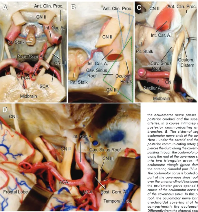 Figure 1. Silicone-injected cadaveric specimens have been dissected to demonstrate the microsurgical anatomy of the oculomotor nerve and its topographical relationships