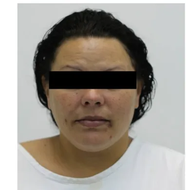 Figura 1 - Aspecto extrabucal frontal da paciente em 2014.