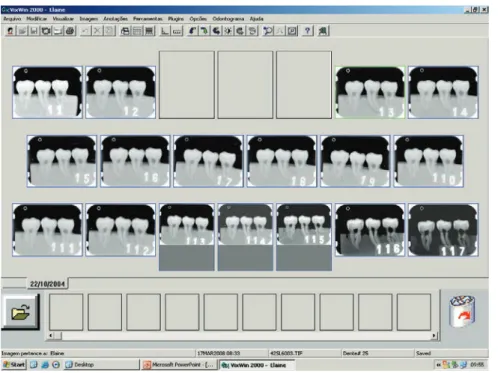 Figure 3 - Example of a series of radiographs in the DenOptix digital system  with adjustments to enhance image quality.