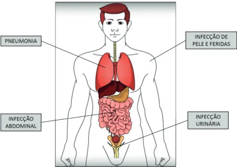 Figura 3 – Principais infecções indutoras da sepse: Pneumonia, infecção  urinária, infecção abdominal, infecção de pele e de feridas, entre outras.