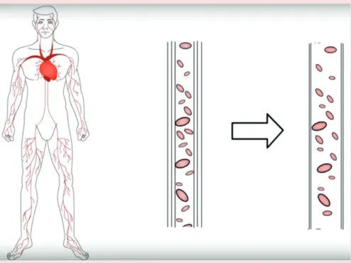 Figura 2 – Vasodilatação causando a hipotensão (PAM < 65mmHg).