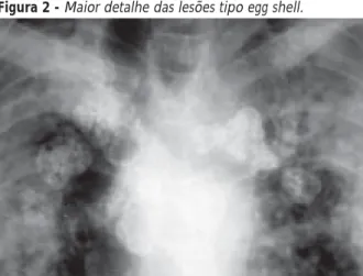 Figura 2 - Maior detalhe das lesões tipo egg shell.