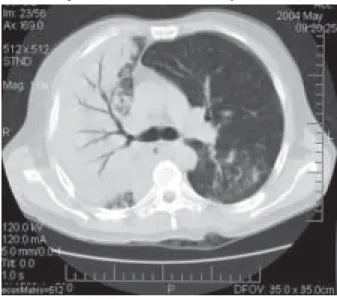 Figura 1 – Radiografia de tórax mostrando imagem de consolidação em lobo superior direito.