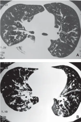 Fig 2 (A e B) - Espessamento bilateral das bainhas conjuntivas peribroncovasculares, e de septos interlobulares