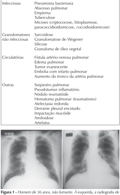 Figura 2 -  À esquerda, a radiografia de tórax mostra massa hilar esquerda em mulher fumante