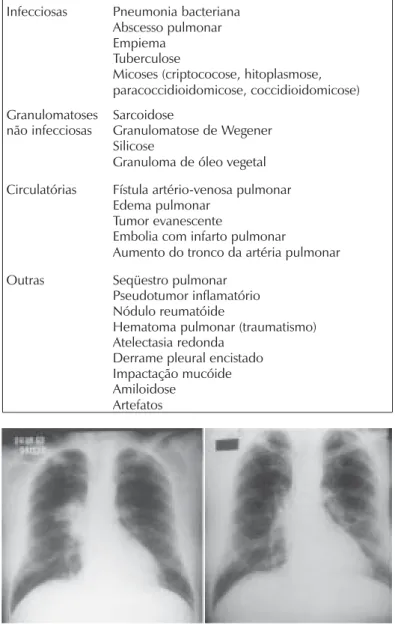 Figura 1 - Homem de 36 anos, não fumante. À esquerda, a radiografia de tórax mostra condensação no hilo direito que sugere neoplasia maligna.