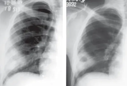 Figura 3 – À esquerda, o spot da radiografia de tórax em PA mostra imagem circunscrita em terço inferior de hemitórax direito