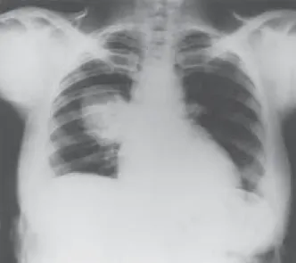 Figura 6 – Radiografia de tórax mostra imagem tumoral no segmento 6 do pulmão direito