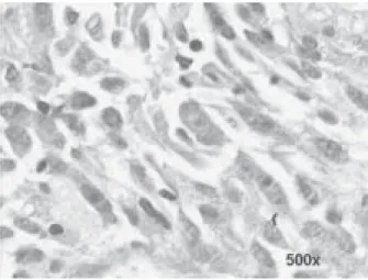 Figura 5 – Caso 2 - A PAAF do tumor revelou presença de células muito grandes, dispersas ou frouxamente agregadas e bastante anaplásicas, muitas delas fusiformes, com citoplasma uni ou bipolar, com núcleos alongados (em forma de charuto), de cromatina gros