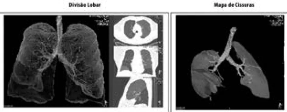 Figura 3. Mapeamento com software dedicado (VIDA Diagnostics) da integridade de cissuras inter- inter-lobares