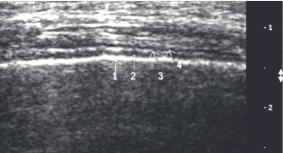 Figura 1.  Ultrassonografia pleural. 1 - Pleura visceral; 2 - Espaço pleural; 3 - pleura parietal; 
