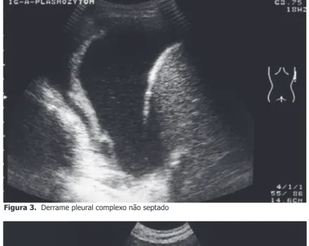 Figura 3.  Derrame pleural complexo não septado