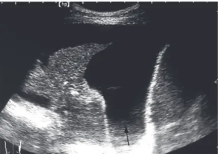 Figura 2.  Derrame pleural simples (anecóico). Pulmão atelectasiado com bronquio pérvio  (seta)