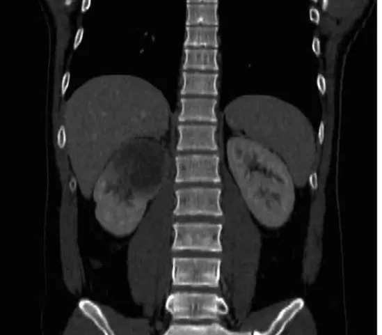 Figura 1. Tomografia computadorizada (corte coronal).