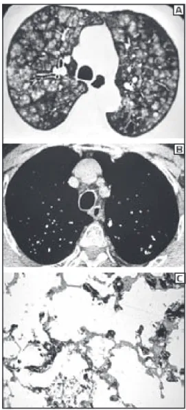 Figura 1 - Em A, TCAR com janela para parênquima pulmonar, mos- mos-trando nódulos predominantemente centrolobulares, mal deﬁnidos,  com  atenuação  em  vidro  fosco,  nos  lobos  superiores