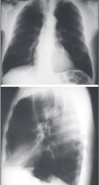 Figura 1 - Radiograﬁa de Tórax: sinais de hiperinsuﬂação pulmonar.