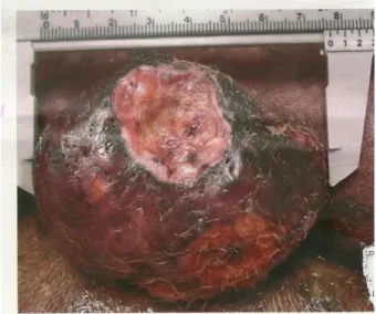 Figura  4  –  Fotografia  de  mastocitoma  cutâneo  de  grau  II  em  face  lateral  de  membro  pélvico  (D),  ulcerado, medindo 7,5 cm em canina, Boxer, 10 anos
