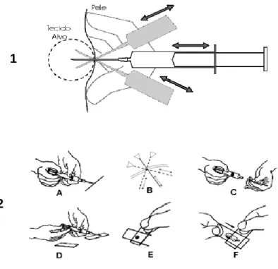 Figura  5  –  Desenho  esquemático  demonstrando  a  colheita  de  material  para  exame  de  citologia