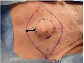 Figura  7  –  Fotografia  da  área  de  incisão  cirúrgica  delimitada  com  caneta  para  marcação  (Skin  Marker), em forma de elipse com margem de segurança de 3cm da borda tumoral (seta dupla), para  exérese de tumor maligno