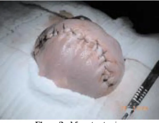 Figura 2 – Miometrectomia