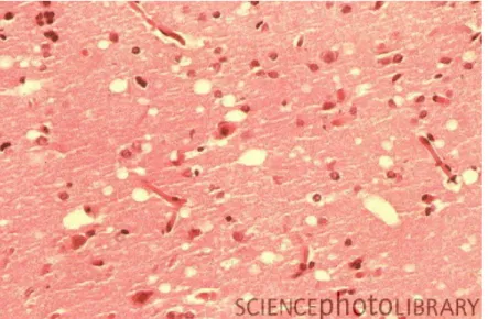 Figura   9:   Doença   de   Creutzfeldt-Jakob.   Micrografia   de   luz   de   uma   secção   de   cérebro  mostrando a doença de Creutzfeldt-Jakob